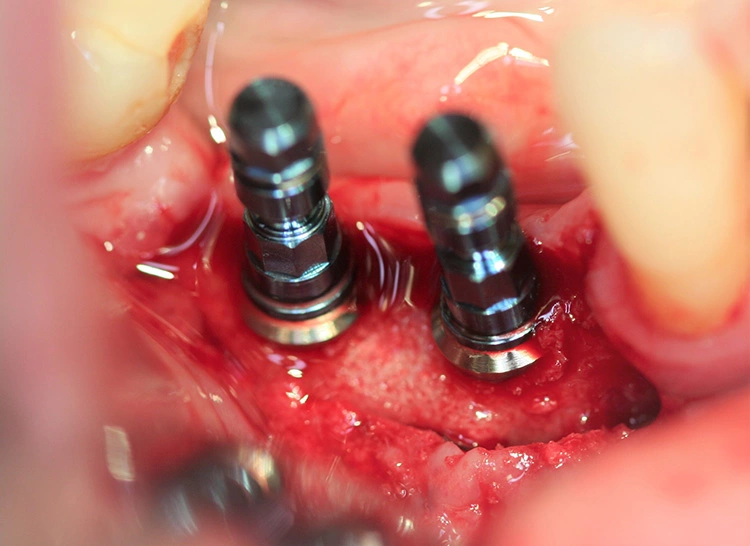 Abb. 8: Inserierte Tissue-Level-Implantate Straumann 3,3 x 10mm SLA RN.
