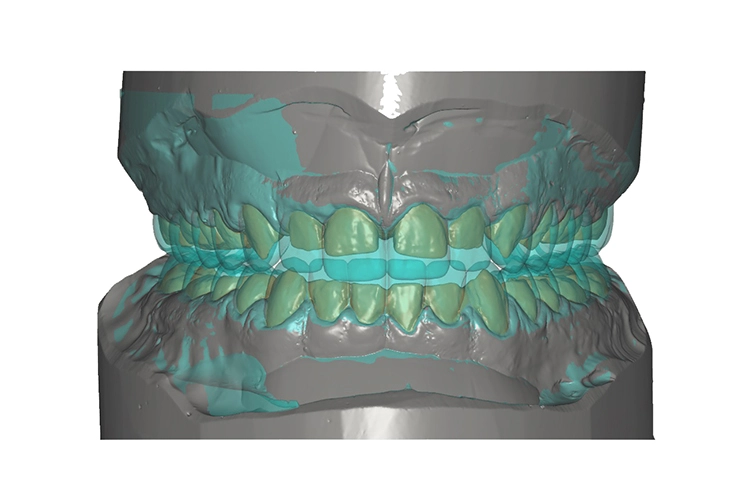 Abb. 8 u. 9: Basierend auf den Erkenntnissen des Wax-up und des Mock-up kann mithilfe moderner CAD-Software die dreidimensionale Form kopiert und für die Konstruktion der Schienen verwendet werden.