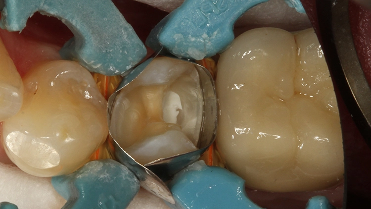 Abb. 8: Dargestellte Kavität vor der Adhäsivbehandlung. Eine Pulpaeröffnung distal wurde bereits überkappt.