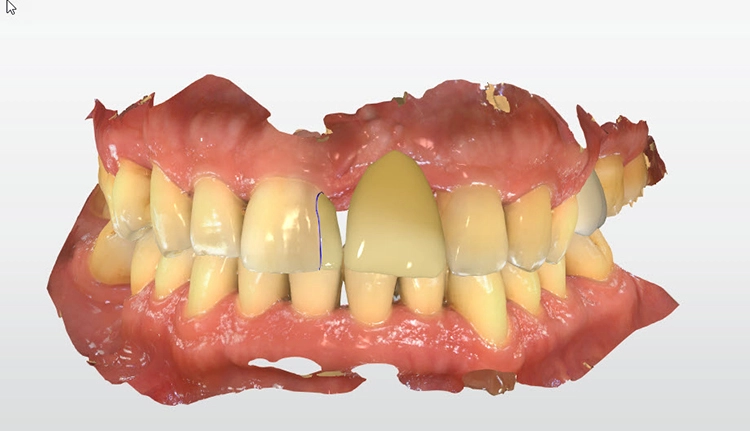 Abb. 8: Auf Grundlage des Digital Smile Design wurden die langzeitprovisorischen Restaurationen konstruiert.