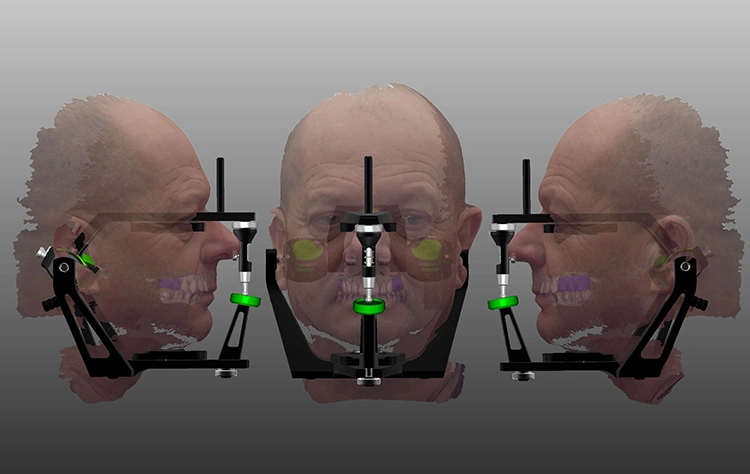 Abb. 8: Die Stützzone im Seitenzahnbereich konnte anhand der Informationen aus dem Face Scan ebenfalls konstruiert werden.
