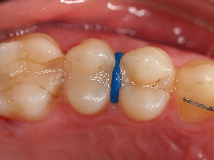 Abb. 8: Die Zahnseparation mit einem orthodontischen Separiergummi ermöglicht eine direkte klinische Untersuchung der Approximalflächen nach dessen Entfernung.