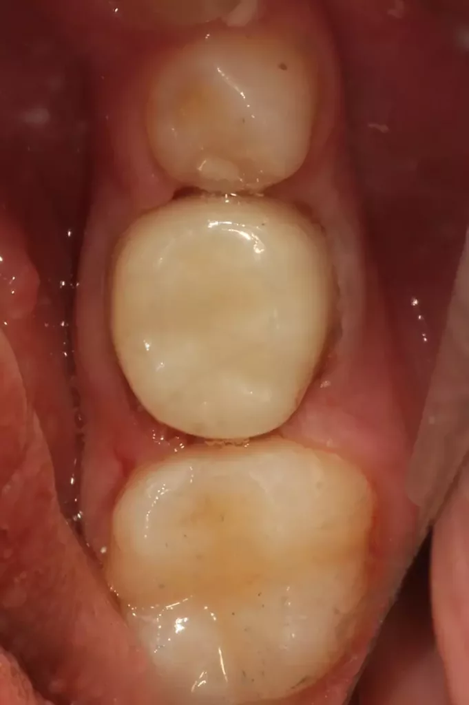 Kinderzirkonjacketkrone sofort nach dem Einsetzen.