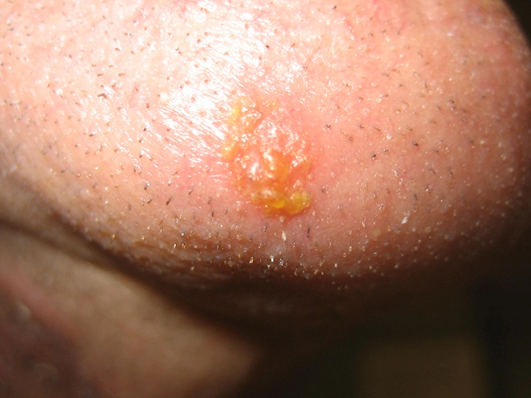 Abb. 8: Impetigo contagiosa im Kinnbereich: goldgelbe Krusten einer relativ homogenen ovalären Läsion. Nachweis von Streptococcus pyogenes.
