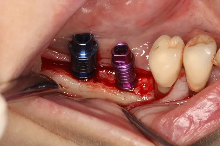 Abb. 8: Inserierte Conelog (Camlog) Implantate in regio 45 (4,3/11 mm) und 46 (5,0/11mm).