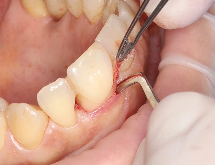 Abb. 8: Entfernung des Superfloss und Offenhalten der erreichten Dehnung mit dem Raspatorium.