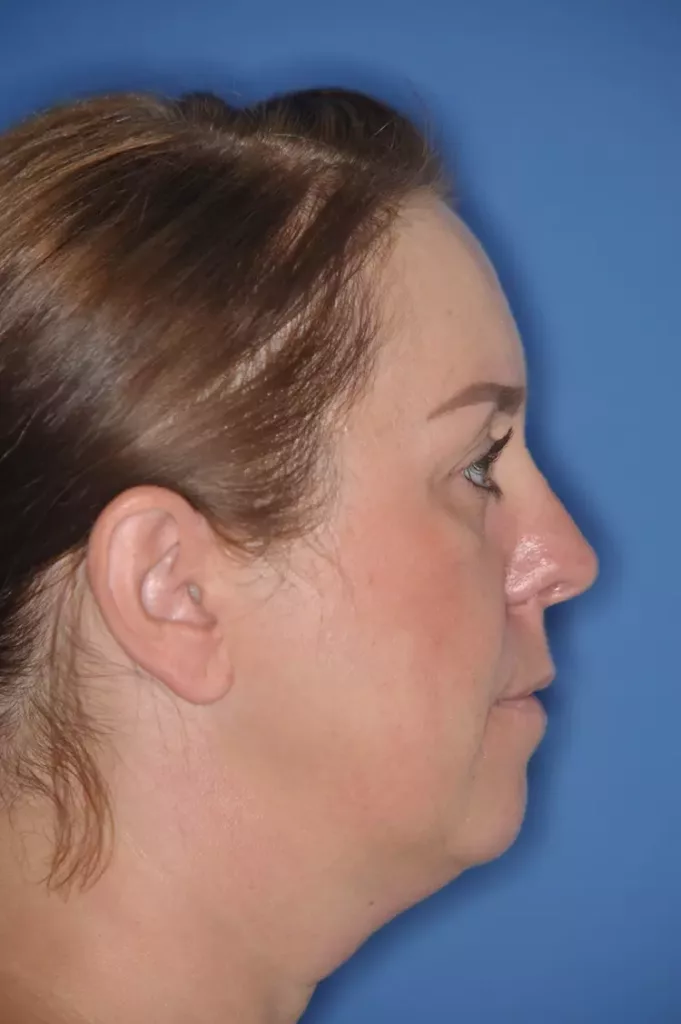 Patientin mit Dysgnathie und mit dem
Wunsch nach Korrektur des fliehenden Kinns, Le
Fort/-Osteotomie und Kinnplastik mittels SchubladenFlügeltechnik unter Berücksichtigung der ästhetischen und funktionellen Aspekte bei bekannter
schlafbezogener Atemstörung (Schnarchen). a: Profil prä Op.