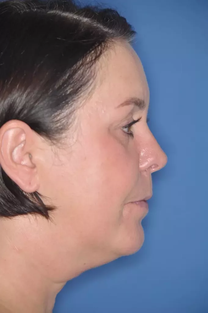 Patientin mit Dysgnathie und mit dem
Wunsch nach Korrektur des fliehenden Kinns, Le
Fort/-Osteotomie und Kinnplastik mittels SchubladenFlügeltechnik unter Berücksichtigung der ästhetischen und funktionellen Aspekte bei bekannter
schlafbezogener Atemstörung (Schnarchen). b: Profil 3 Monate post Op.