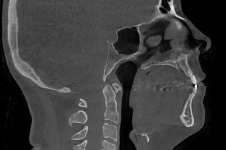 Abb. 8: Patientin mit Dysgnathie und mit dem
Wunsch nach Korrektur des fliehenden Kinns, Le
Fort/-Osteotomie und Kinnplastik mittels SchubladenFlügeltechnik unter Berücksichtigung der ästhetischen und funktionellen Aspekte bei bekannter
schlafbezogener Atemstörung (Schnarchen). c: DVT Median-Sagittalschnitt prä Op.