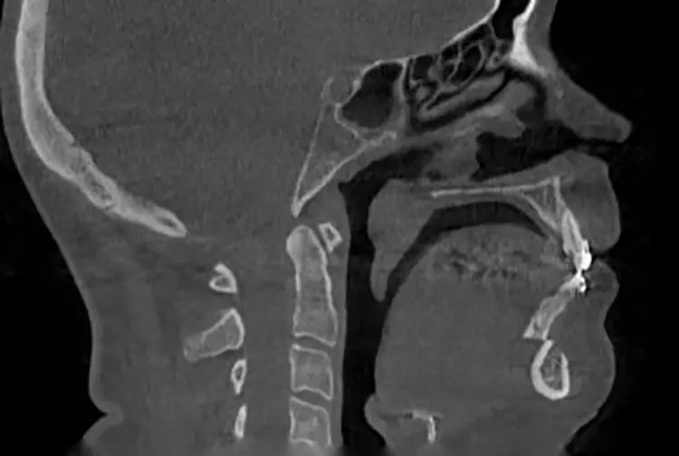 Abb. 8: Patientin mit Dysgnathie und mit dem
Wunsch nach Korrektur des fliehenden Kinns, Le
Fort/-Osteotomie und Kinnplastik mittels SchubladenFlügeltechnik unter Berücksichtigung der ästhetischen und funktionellen Aspekte bei bekannter
schlafbezogener Atemstörung (Schnarchen). d: DVT Median-Sagittalschnitt post Op, deutlich
mehr Zungenfunktionsraum.
