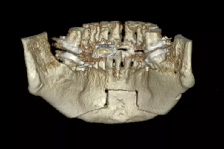 Abb. 8: Patientin mit Dysgnathie und mit dem
Wunsch nach Korrektur des fliehenden Kinns, Le
Fort/-Osteotomie und Kinnplastik mittels SchubladenFlügeltechnik unter Berücksichtigung der ästhetischen und funktionellen Aspekte bei bekannter
schlafbezogener Atemstörung (Schnarchen). e: DVT post Op, Osteotomielinie von lingual.