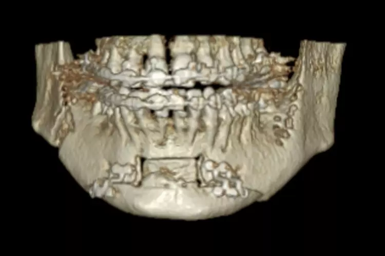 Abb. 8: Patientin mit Dysgnathie und mit dem
Wunsch nach Korrektur des fliehenden Kinns, Le
Fort/-Osteotomie und Kinnplastik mittels SchubladenFlügeltechnik unter Berücksichtigung der ästhetischen und funktionellen Aspekte bei bekannter
schlafbezogener Atemstörung (Schnarchen). f: DVT post Op, Osteotomielinie von frontal,
Osteosynthese und Abschrägung des Segmentes
an der oberen Kante zur Anpassung der Stufe
entsprechend der Sublabialfalte.