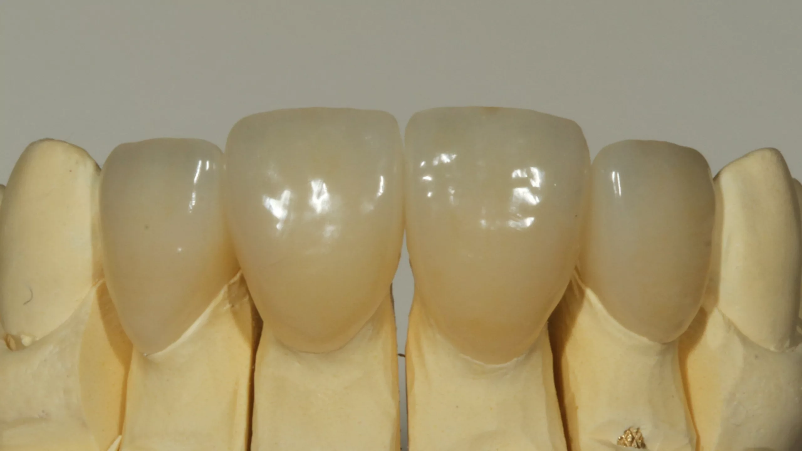 Abb. 31: Neuversorgung aus labial verblendetem, monolithischem Zirkonmaterial.