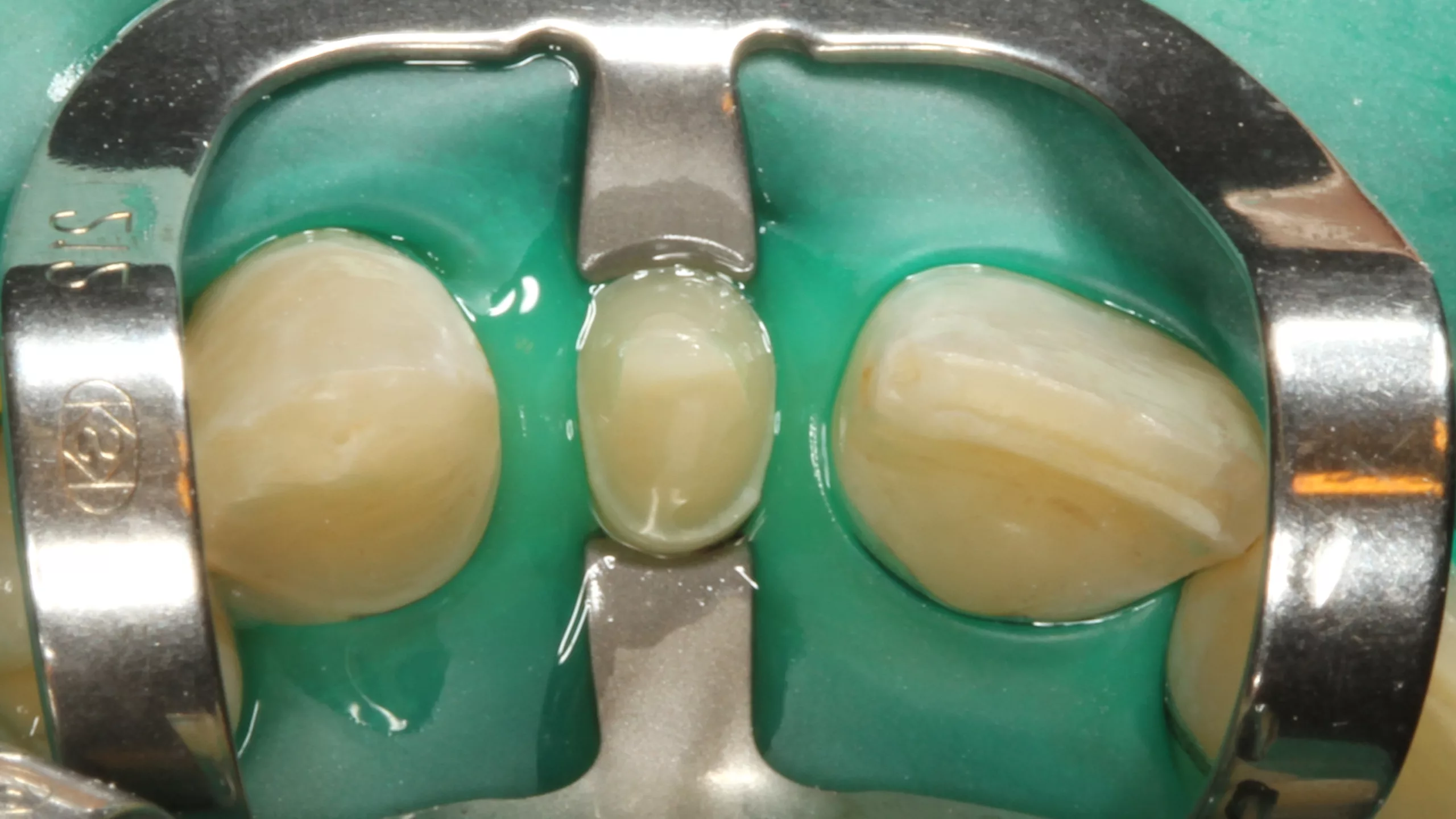 Abb. 23: Einwirken des Visalys Tooth Primers für 20 Sek. (inzisale Ansicht).