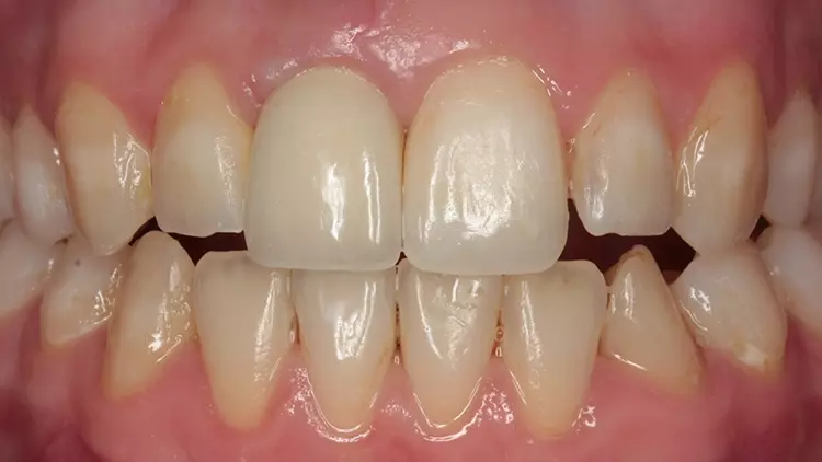 Abb. 8c: Prospektive Implantation mit Antizipieren des Restwachstums im Alter
von 19 Jahren; geänderte prothetische Versorgung; positiver Überschuss im Emergenzprofil für weiteres Wachstum.