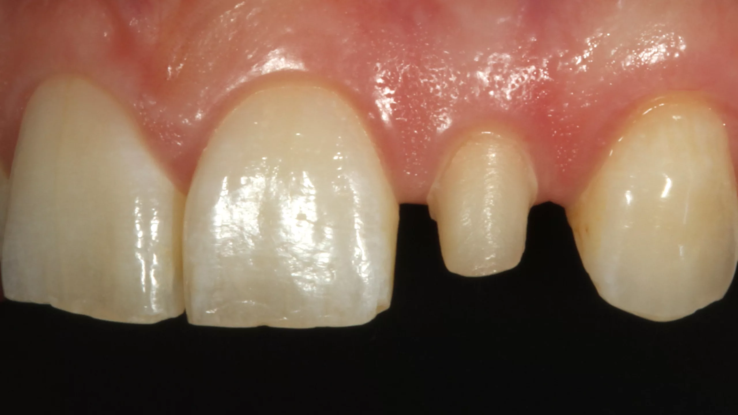 Abb. 11: Detailansicht der Ausgangssituation an Zahn 22.