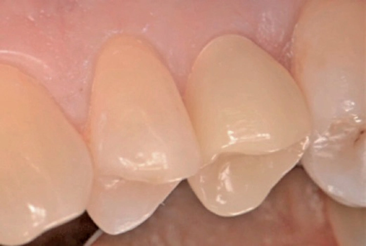 Abb. 14: Die Keramik-Restauration 3 Monate nach Implantation.