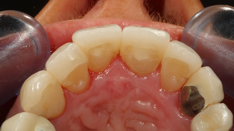 Abb. 21: Behandlungsergebnis unmittelbar nach Fertigstellung in Ansicht von labial.