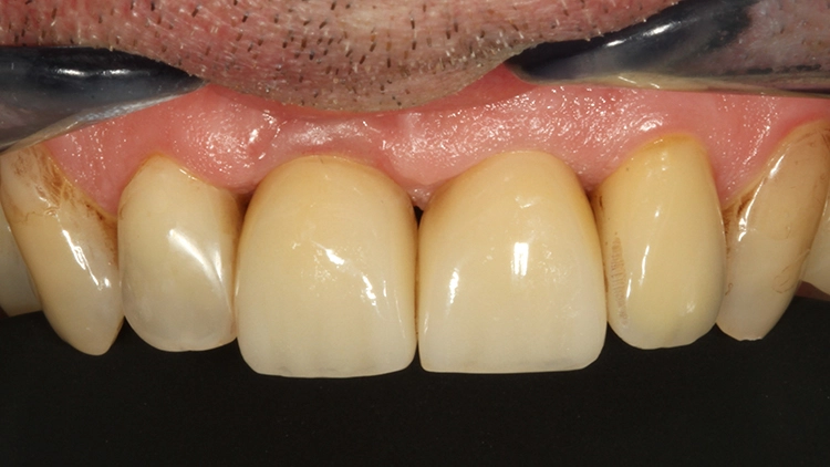 Abb. 23: Das Endergebnis der implantatprothetischen Versorgung der beiden mittleren Schneidezähne sowie die konservierend-restaurative kleine Ergänzung am Zahn 12 approximal-zervikal.