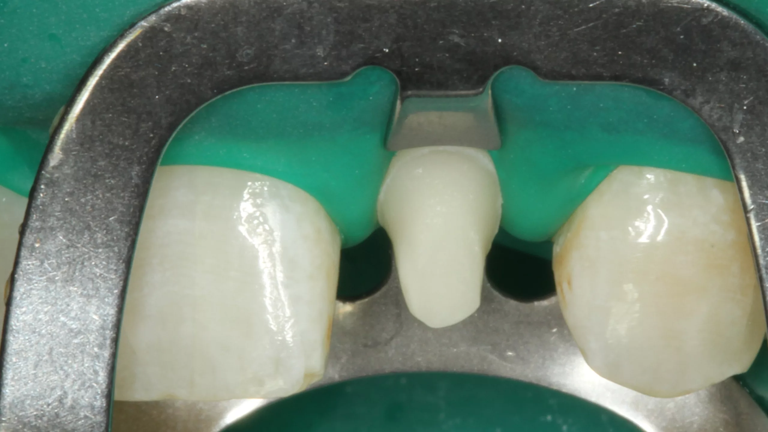 Abb. 19: Der mit Kofferdam isolierte Zahn 22 nach der Reinigung der Oberfläche.