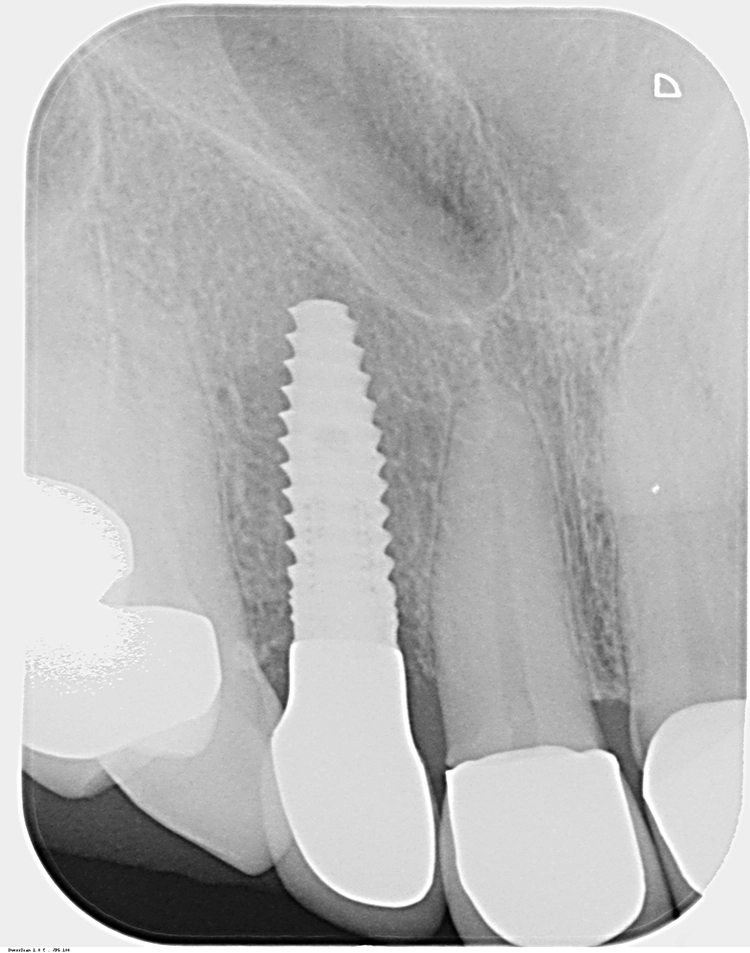 Abb. 29: Zahnfilm und Röntgenkontrolle des Implantats in regio 12 nach Kronenversorgung.