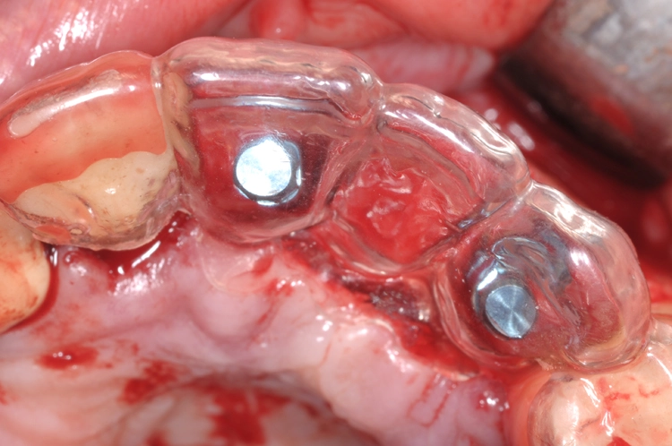 Abb. 10: Implantation von BLT-Implantaten (Länge: 12 mm, Ø 4,1 mm, Straumann) in regio 21 und 23 mit Hilfe einer Orientierungsschablone, Ausrichtung der Implantate für eine verschraubte Brücke.
