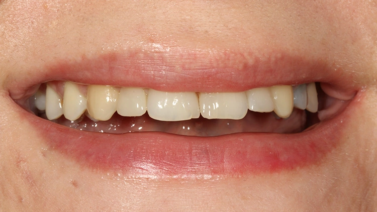 Abb. 24: Lippenbild nach Behandlungsabschluss der Zähne 12 und 22.