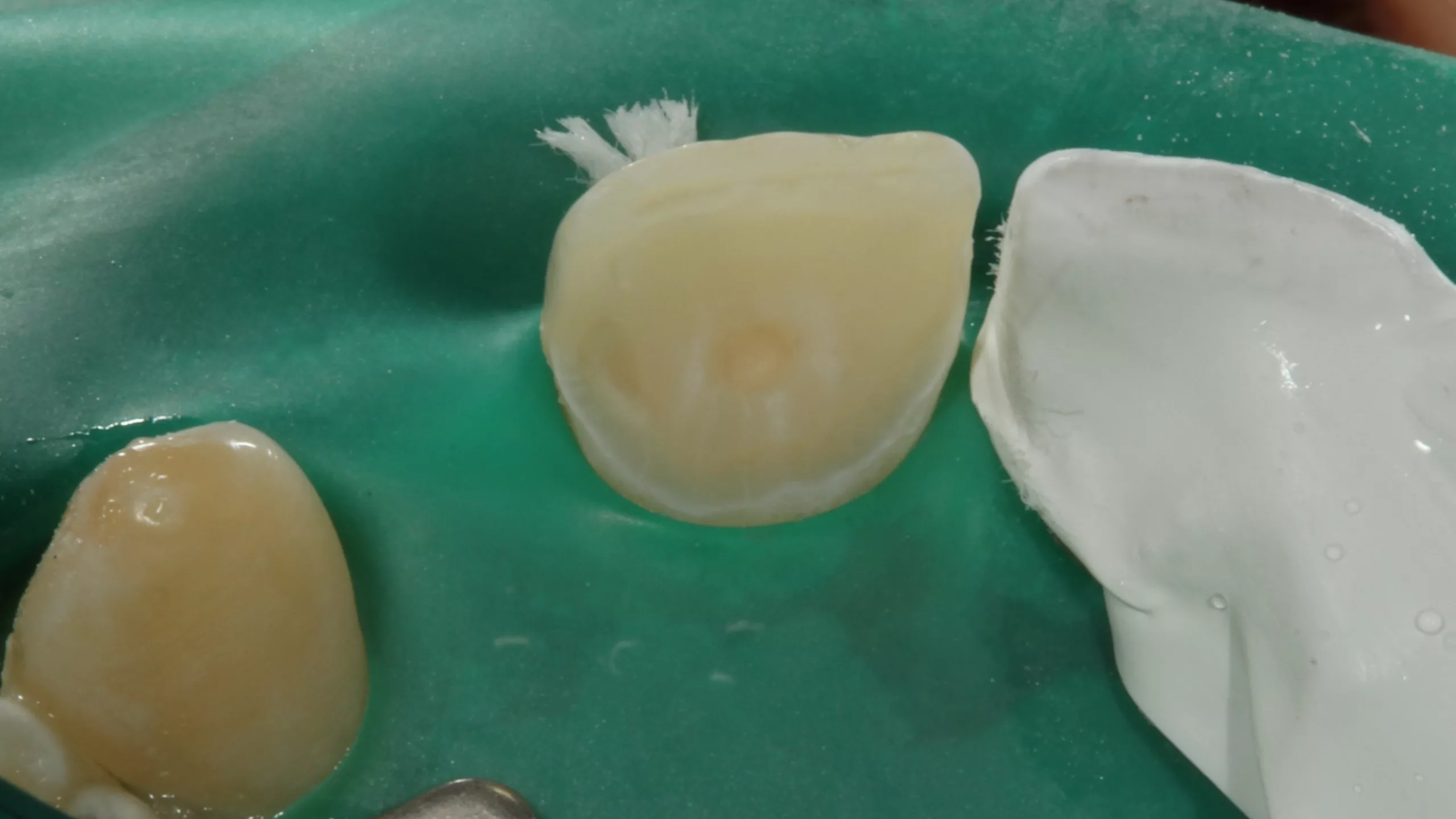 Abb. 47: Die geätzte Zahnstruktur der Palatinalfläche des Zahnes 21.