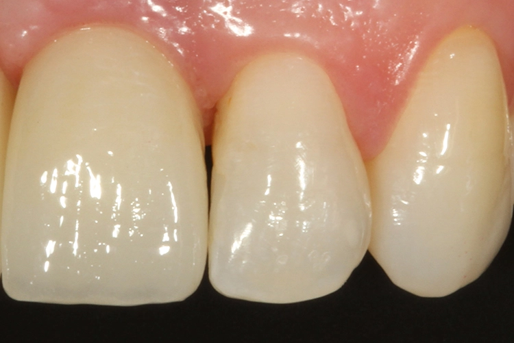 Abb. 9: Diskreterer Behandlungsbedarf äquivalent an Zahn 22 mesial.