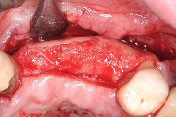 Abb. 9: Erneute Glättung schärferer Kanten vor Implantation.