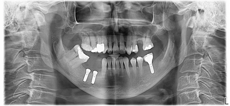 Abb. 9: OPG-Aufnahme nach Implantation.