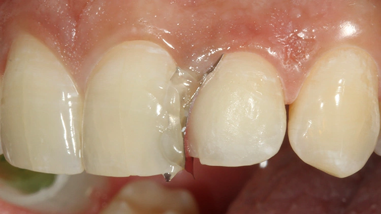 Opaker Dentinkern aus der Dentinfarbe Tetric Prime A2 Dentin.