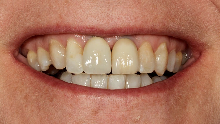 Abb. 9: Lippenbild der Patientin. Trotz der farblich nicht exakt zueinander passenden Implantatkronen war die Patientin hochzufrieden.