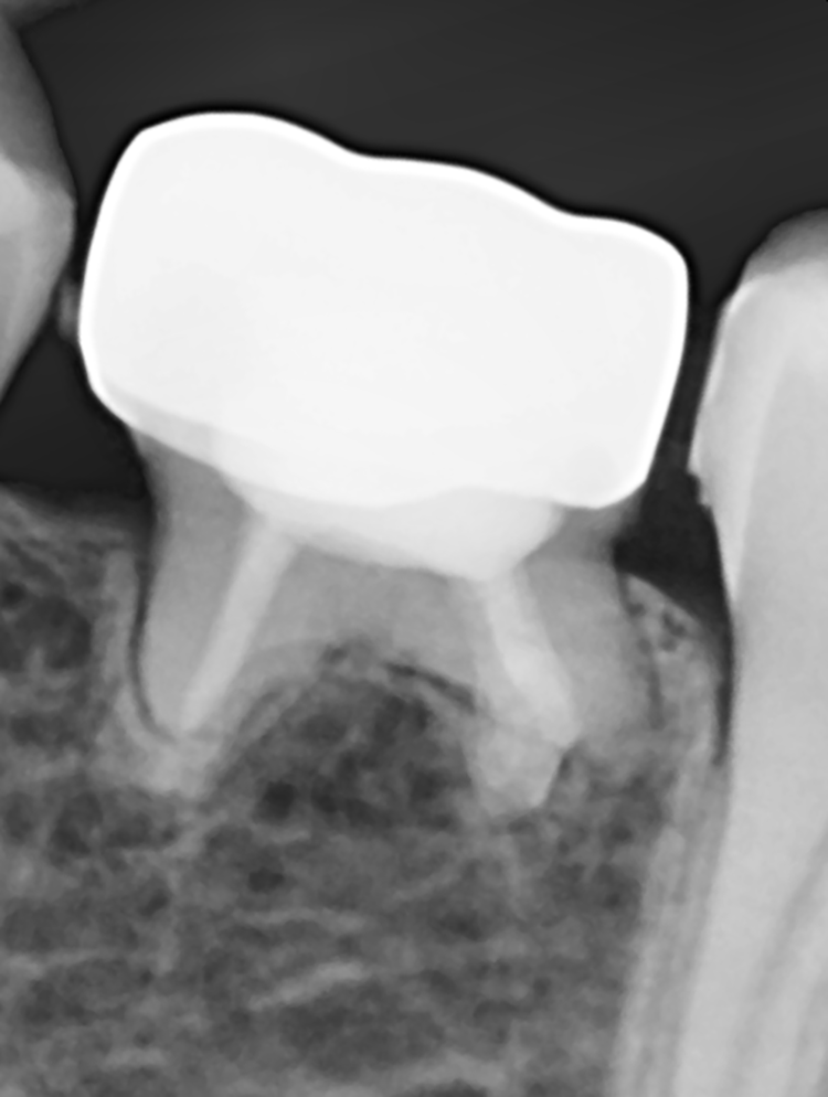 Abb. 9: Röntgenbild 3 Jahren nach
der endodontologischen Versorgung
und 6 Monate nach dem Einsetzen
der Krone.