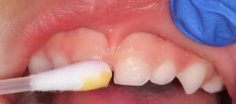 Abb. 9: Fluoridierungsmaßnahmen mit einem Lack
sind in der Zahnarztpraxis ab Juli 2019 2-mal pro
Halbjahr bei Kleinkindern abrechenbar.
Dies ist ein wichtiger Schritt zur Reduktion Frühkindlicher
Karies bei Kleinkindern.
