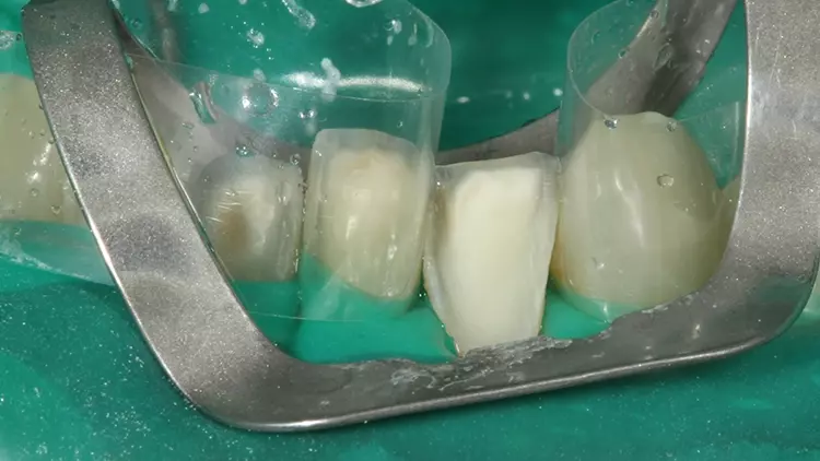 Abb. 9: Isolierung des Arbeitsfeldes mit Kofferdam zur adhäsiven Befestigung
der Veneers: Vorbereitung zur adhäsiven Befestigung der Schale an Zahn 32.