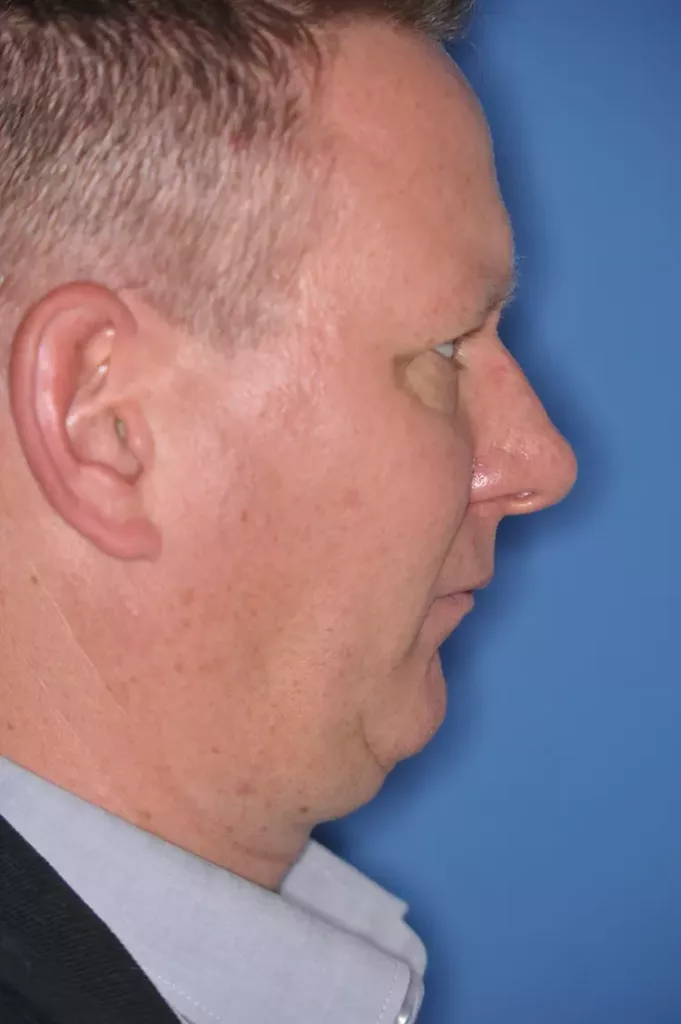 Patient mit mandibulärer Retrognathie und
tiefem Biss, Dysgnathiekorrektur mittels Unterkiefervorverlagerung in toto und zusätzlicher Kinnplastik
mittels Schubladen-Flügeltechnik zur ästhetischen
und funktionellen Verbesserung bei bekannter
schlafbezogener Atemstörung (Schnarchen). a: Profil prä Op.