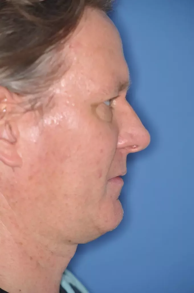 Patient mit mandibulärer Retrognathie und
tiefem Biss, Dysgnathiekorrektur mittels Unterkiefervorverlagerung in toto und zusätzlicher Kinnplastik
mittels Schubladen-Flügeltechnik zur ästhetischen
und funktionellen Verbesserung bei bekannter
schlafbezogener Atemstörung (Schnarchen). b: Profil 3 Monate post Op.