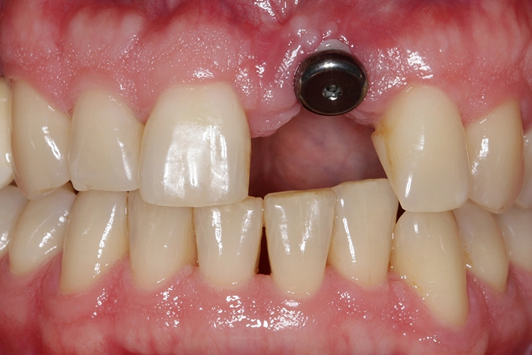 Abb. 9: Zustand nach Osseointegration des Implantats in regio 21 mit Gingivaformer.
