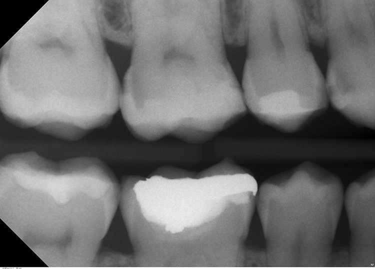 Abb. 9a: Der Befund in der Bissflügelaufnahme eines jungen Erwachsenen mit multiplen (approximalen) Füllungen bestätigt den klinischen Verdacht auf Approximalkaries. Dies ist die röntgenologische Untersuchung zu den in Abbildung 8 dargestellten Zähnen im 1. Quadranten. Im Gegensatz zum klinischen Bild in Abbildung 8 ist röntgenologisch eindeutig beispielsweise an Zahn 14 distal eine
Dentinkaries zu befunden.