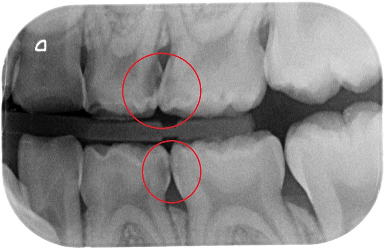 Abb. 9b: Bissflügelaufnahme: Approximalkaries an Milchmolaren (rot umrandet) kann oftmals erst in einem Röntgenbild identifiziert werden. Auch das Risiko einer möglichen Beteiligung der Pulpa kann deutlich besser abgeschätzt werden.