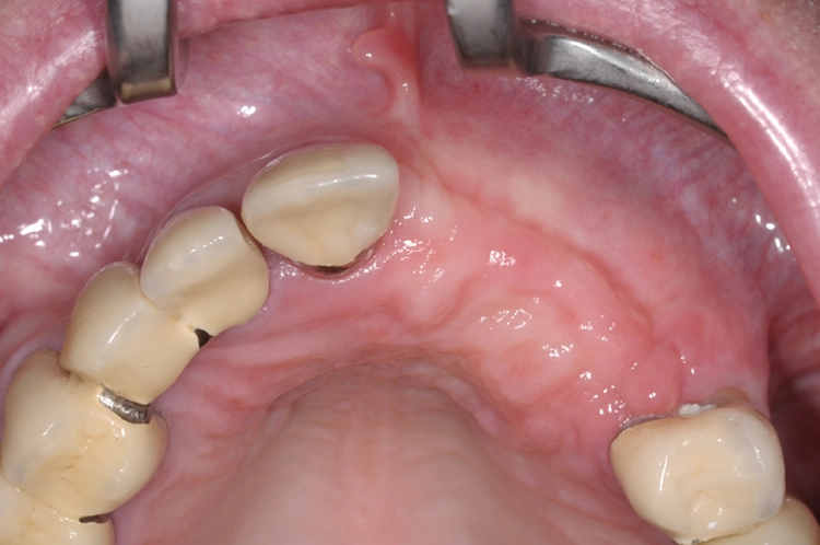 Abb. 13: Situation vor operativer Freilegung der Implantate regio 21 und 23.