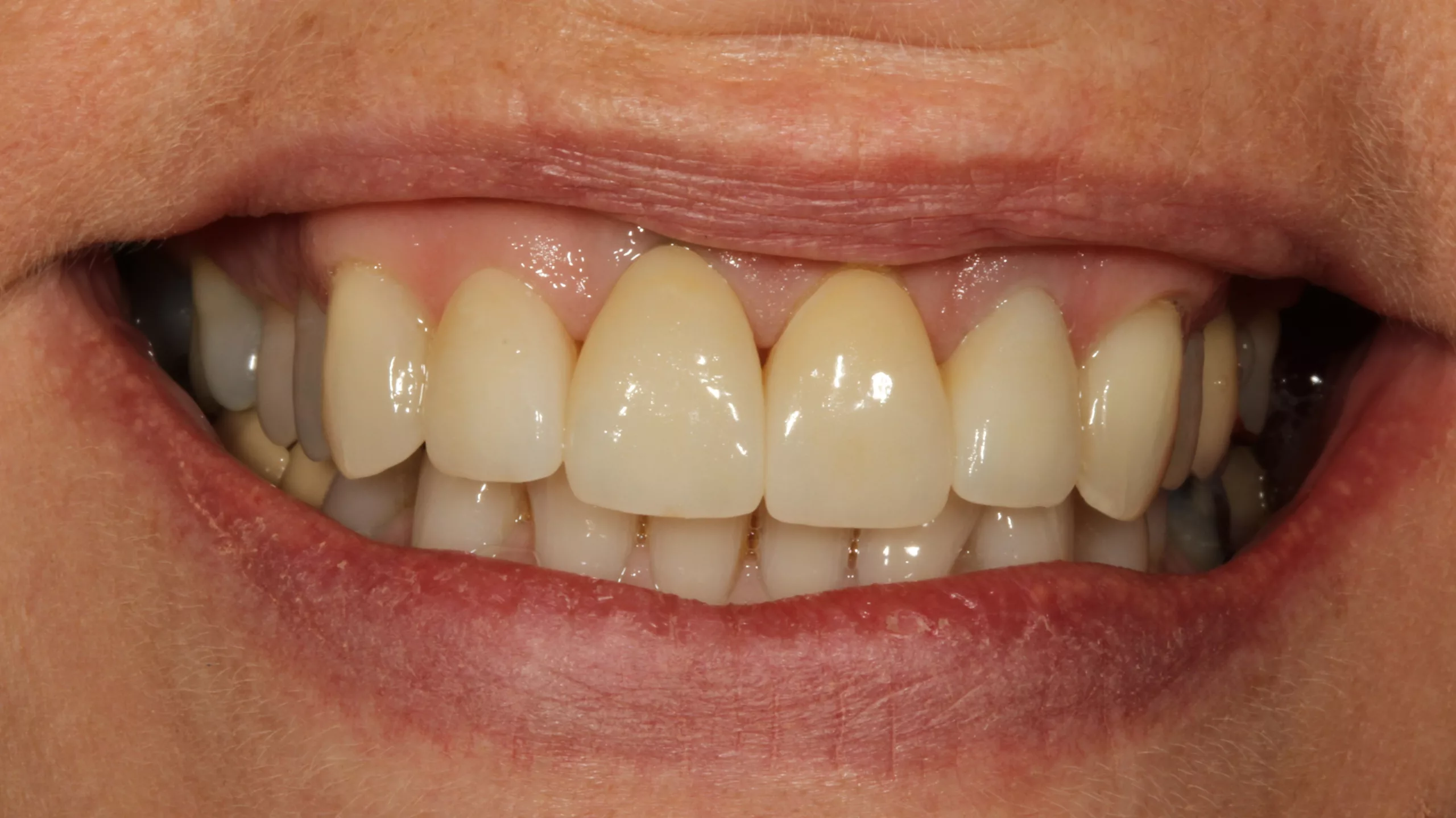 Abb. 36: Das zufriedene neue Lächeln der Patientin.