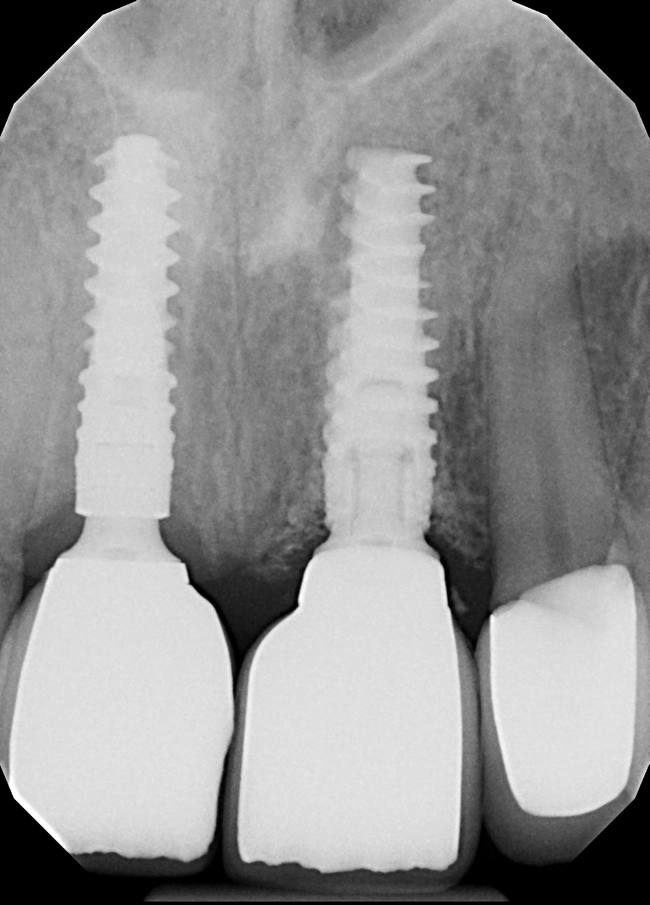Abb. 21: Röntgenkontrollaufnahme nach Einsetzen der Implantatkrone auf Zahn 11.