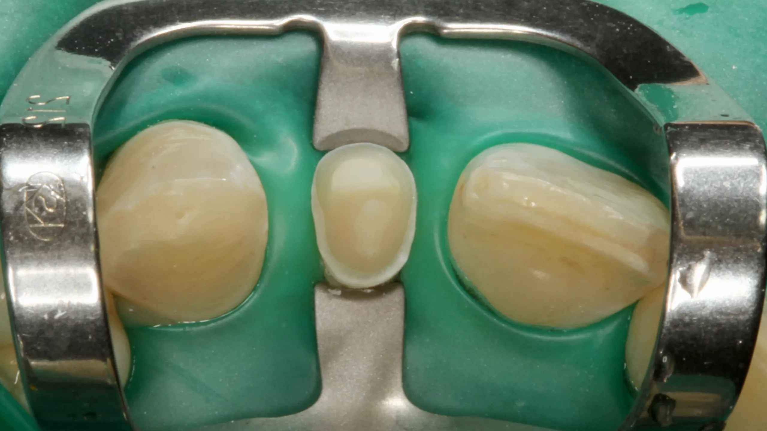 Abb. 21: Der konditionierte Zahnstumpf aus inzisaler Sicht.