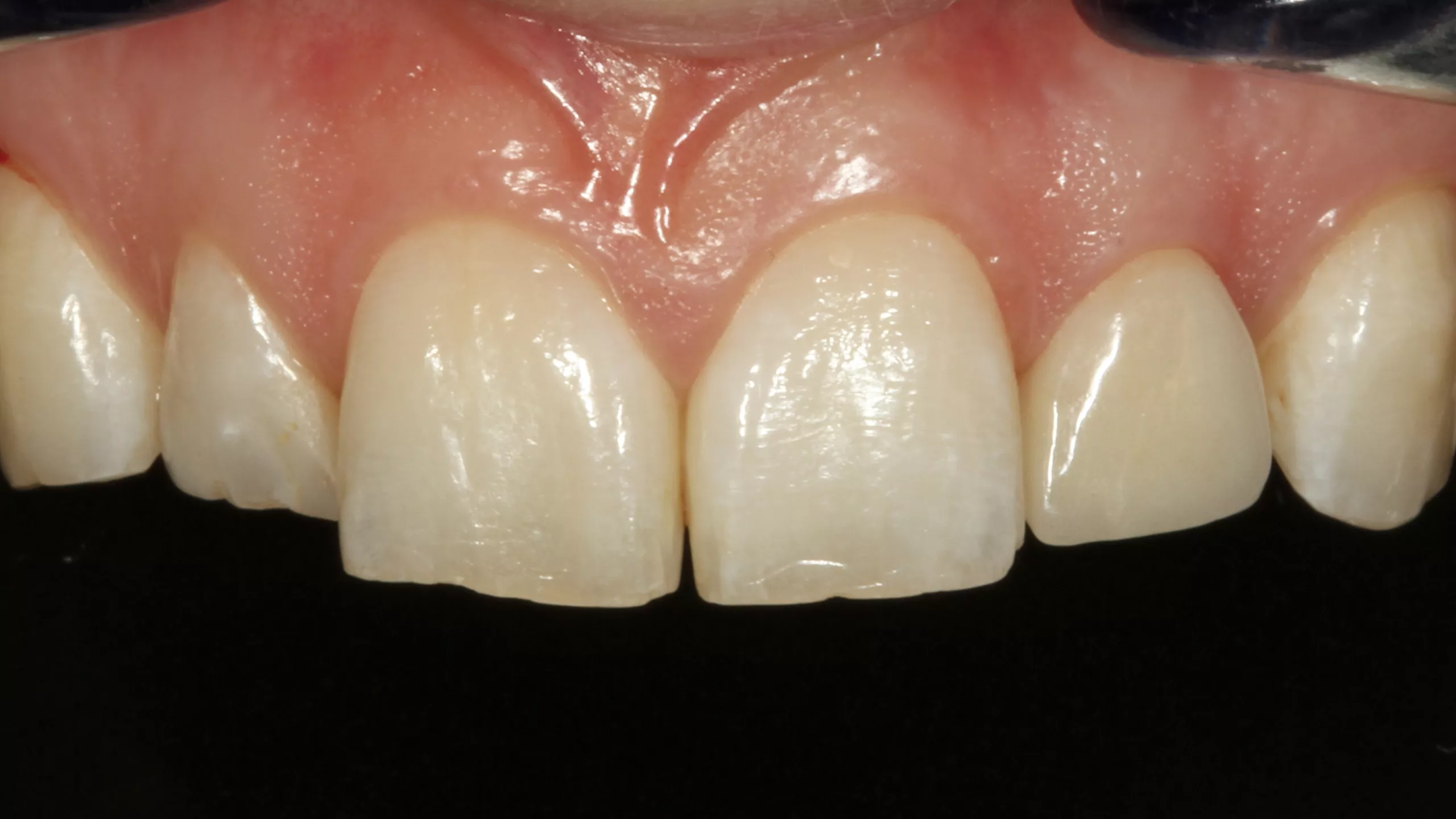Abb. 27: En-face-Ansicht der fertiggestellten Neuversorgung an Zahn 22.