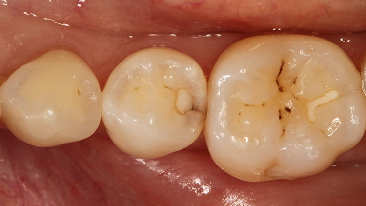 Abb. 20: Klinisch gut erkennbare Karies distal an Zahn 45 – vergesellschaftet mit einer insuffizienten kleinen okklusalen Füllung in der distalen Fissur.