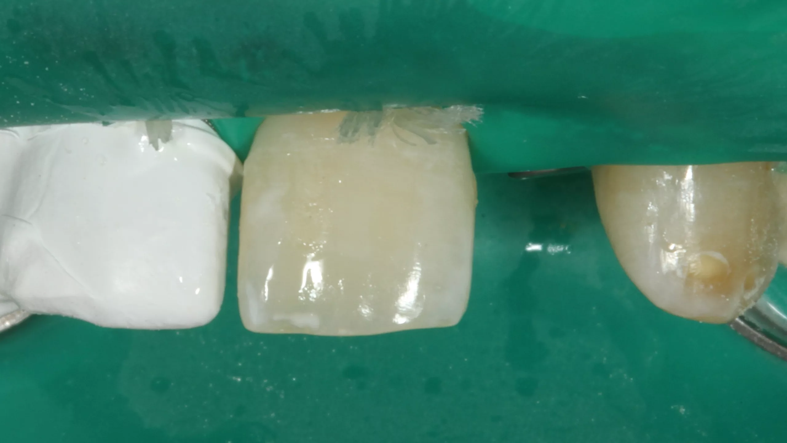 Abb. 45: Isolierte Arbeitsfläche in Ansicht von labial.