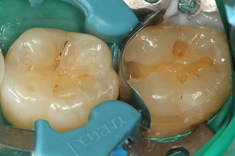Abb. 26: Die Verschalung erfolgte erneut mit einer Contact Matrix Ultra thin flex Teilmatrize, einem Garrison Fusion-Wedge und einem Palodent Plus-Spannring.