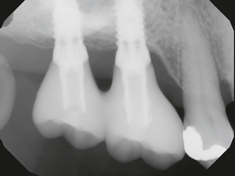 Abb. 19 und 20: Vier Jahre nach Versorgung mit stabilem Hartgewebe und spaltfreiem Interface für den form- und kraftschlüssigen Verbund zwischen Implantat
und Aufbau.